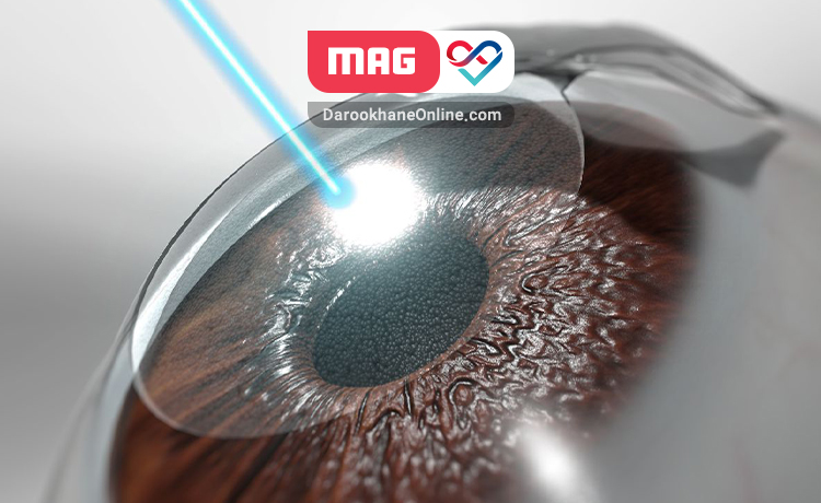 عمل جراحی لیزیک چشم به چه هدف و چگونه انجام می شود؟