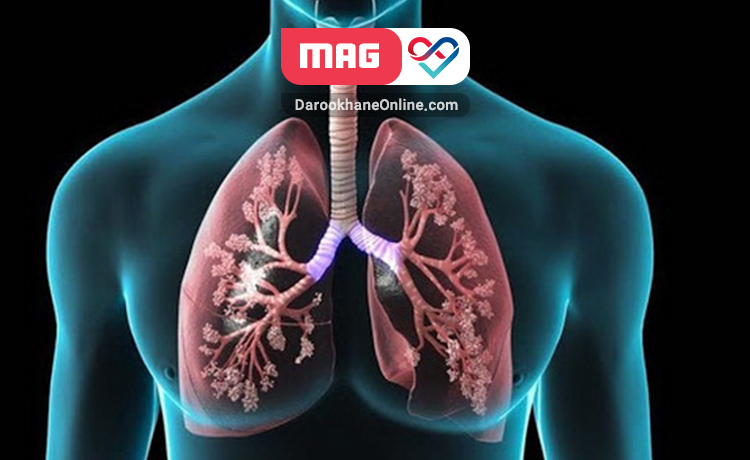 عفونت حاد تنفسی چیست؟