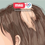 ریزش موی سکه ای در اثر چه عواملی رخ می دهد؟
