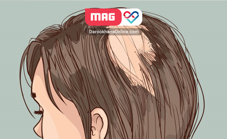 ریزش موی سکه ای در اثر چه عواملی رخ می دهد؟