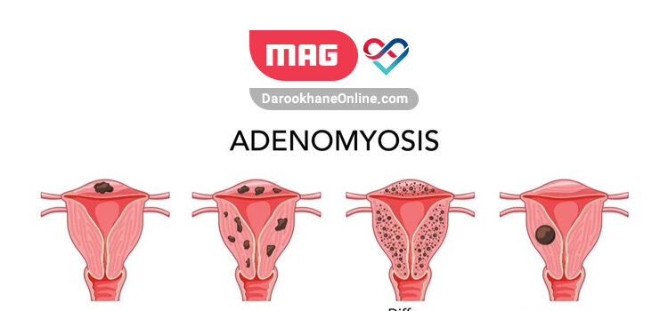 adenomyosis 2