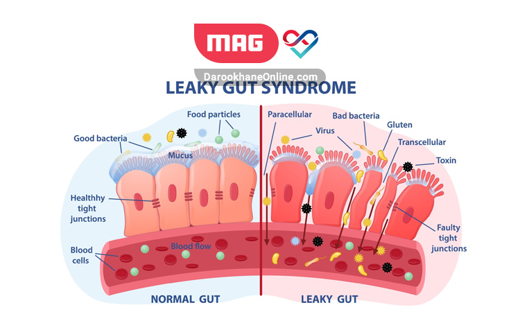 leaky gut 1