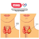 thyroid nodules 1