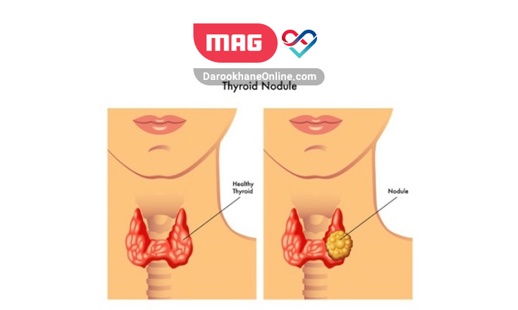 thyroid nodules 1