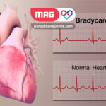 bradycardia 1