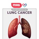 lung cancerr