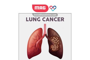 lung cancerr