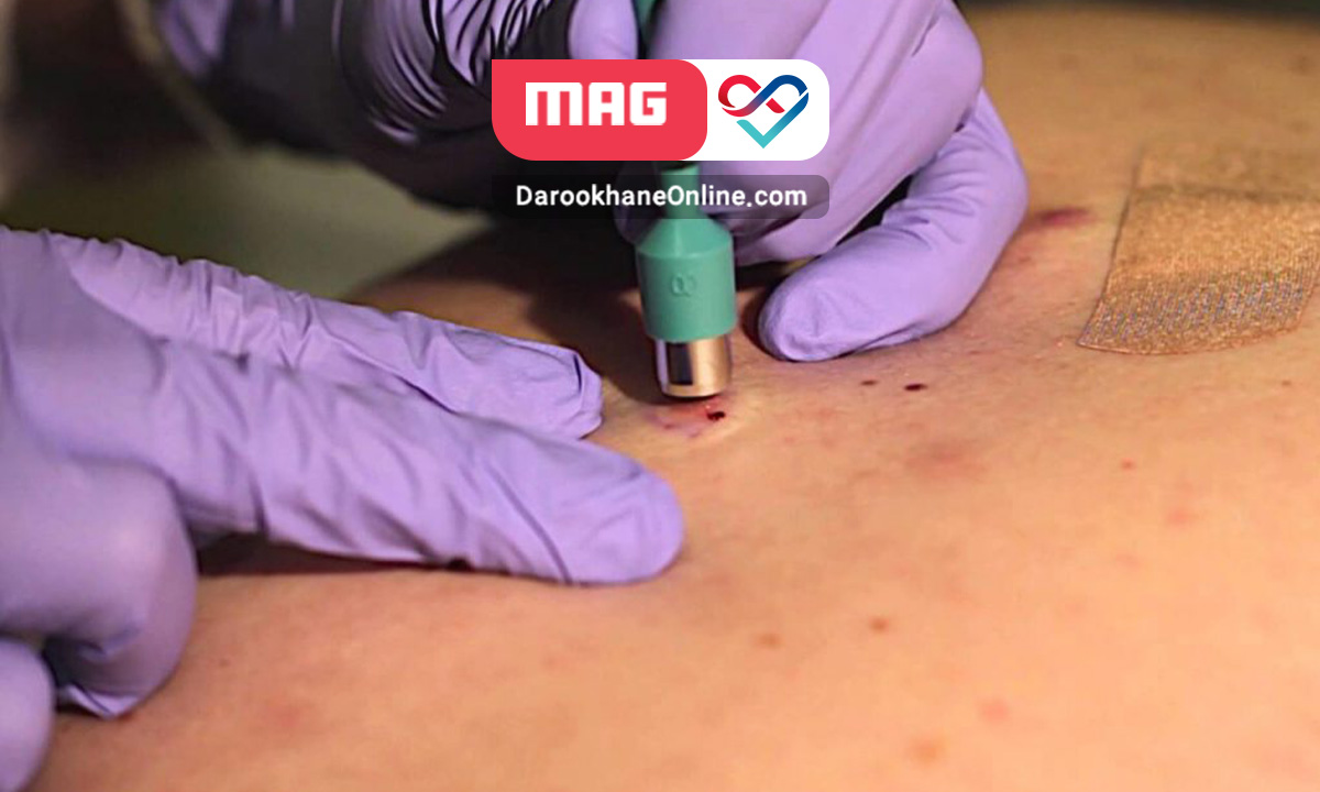 بیوپسی یا نمونه برداری چیست و چه کاربردی دارد؟ نمونه برداری