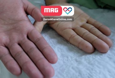 کم خونی آپلاستیک