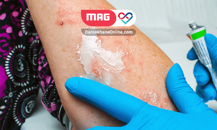 نقش داروی تازاروتن در درمان پسوریازیس داروی تازاروتن