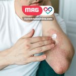 داروی تازاروتن