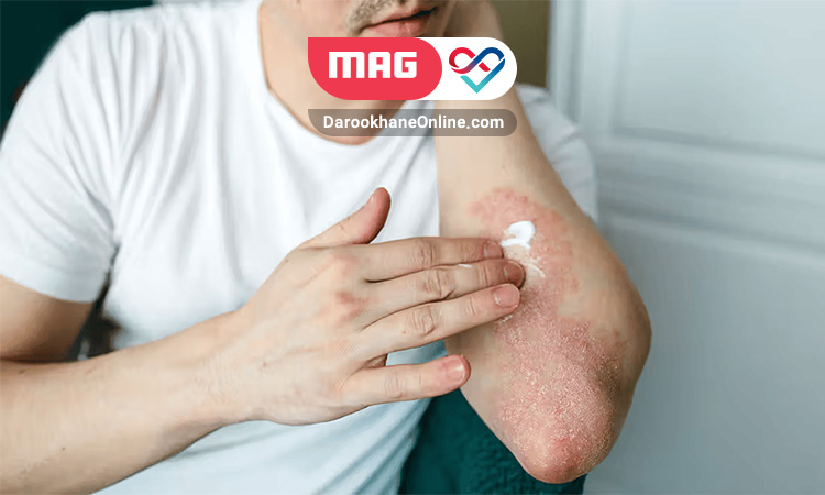 نقش داروی تازاروتن در درمان پسوریازیس داروی تازاروتن