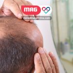 ریزش مو پس از کاشت