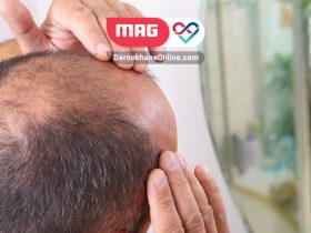 ریزش مو پس از کاشت