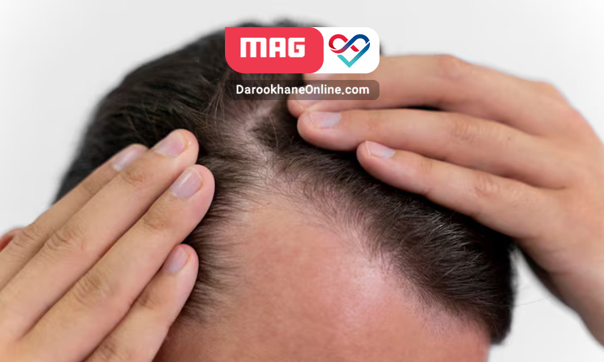 قویترین داروی رشد مجدد مو؛ بررسی کامل روش ها داروی تقویت رشد مو