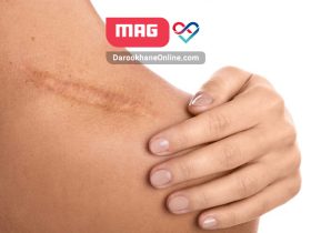 از بین بردن جای زخم: راهنمای جامع و سریع برای حذف جای زخم از-بین-بردن-جای-زخم-راهنمای-جامع-و-سریع-برای-حذف-جای-زخم