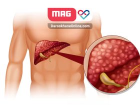 علائم-کبد-چرب