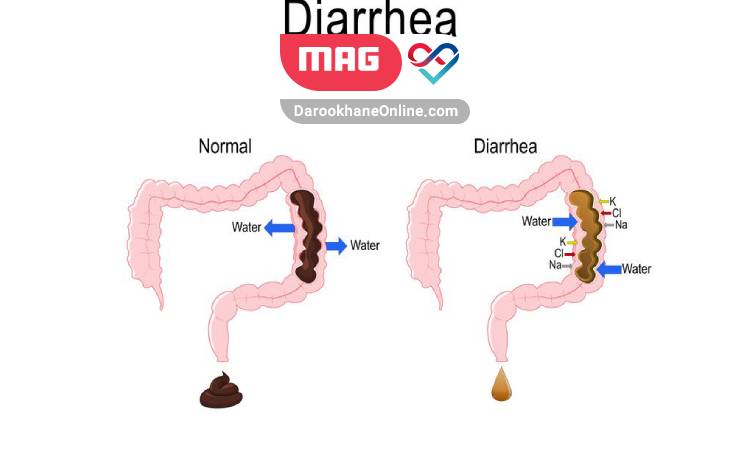 راه های درمان سریع اسهال